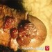 Image of زگیل تناسلی چیست و آیا درمانی دارد | اینفوسلامت